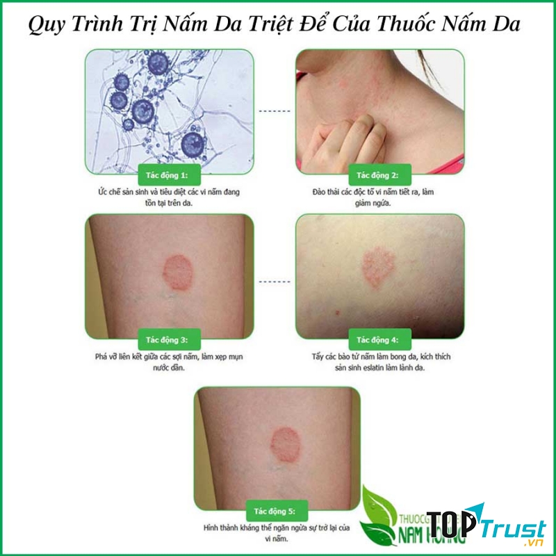 Thuốc Trị Nấm Da Đông Y Gia Truyền Nam Hoàng