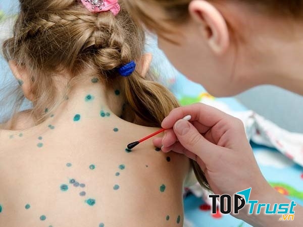 Triệu chứng đầu tiên khi bị bệnh là người bệnh rất mệt mỏi, đau đầu, sốt cao, trên người nổi các nốt phỏng màu hồng có nước bên trong.