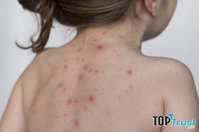 Cần tiêm phòng Vaccine phòng bệnh thủy đậu
