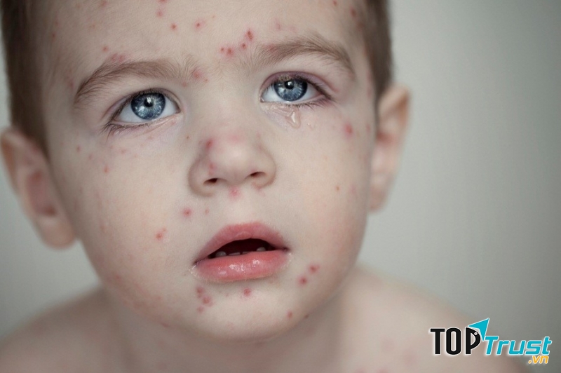 bệnh cóBệnh có khả năng lây lan nhanh chóng, có thể xảy ra ở cả trẻ em (phổ biến hơn) và người lớn.