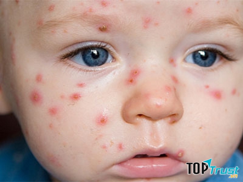 Trẻ nhỏ bị nhiễm thuỷ đậu, mặt xuất hiện nhiều nốt đỏ.