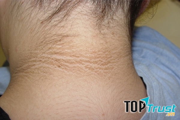 Có khoảng 8 triệu trên 29 triệu ca tiểu đường được chẩn đoán quá trễ