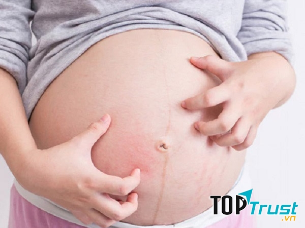 Sau khi sinh em bé, hiện tượng bị ngứa khi mang thai sẽ tự khỏi.