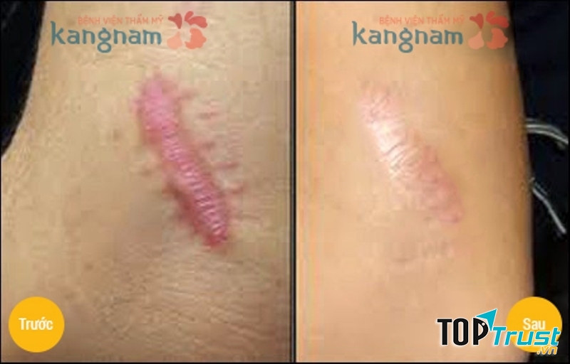 Vết sẹo gần như biến mất sau điều trị