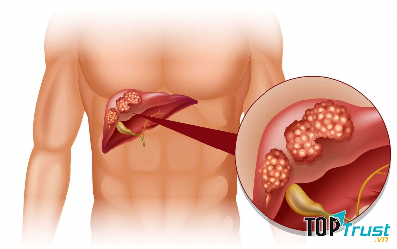 Nếu gan bị tổn thương, ngay lập tức sức khỏe tổng thể sẽ bị đe dọa, ảnh hưởng lớn đến các cơ quan khác.