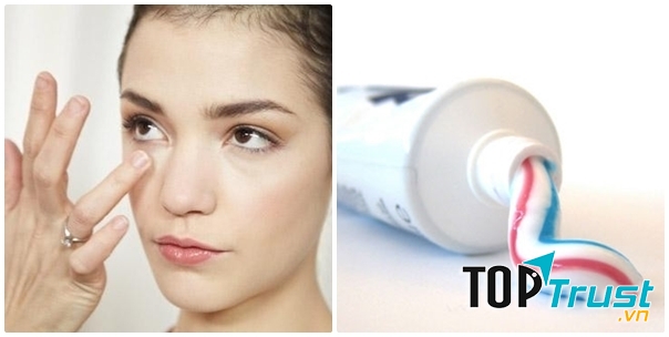 Trị mụn bằng kem đánh răng hiệu quả nhất