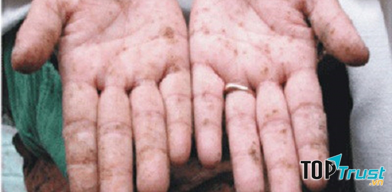 Nhiễm độc chì là nguy hiểm nhất, có thể gây dị dạng thai nhi, ảnh hưởng tới hệ thần kinh sau này, làm tăng nguy cơ xảy thai.