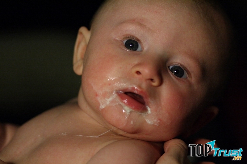 Trào ngược dạ dày dễ nhầm với nôn trớ