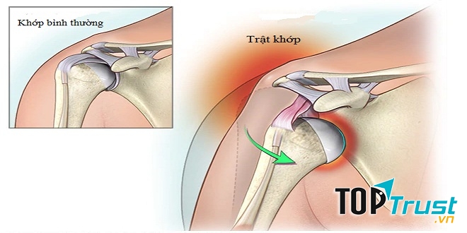 Trật khớp vai là tình trạng các khớp trên vai của bạn trở nên lỏng lẻo, có thể dịch chuyển theo những hướng khác nhau rất bất thường.