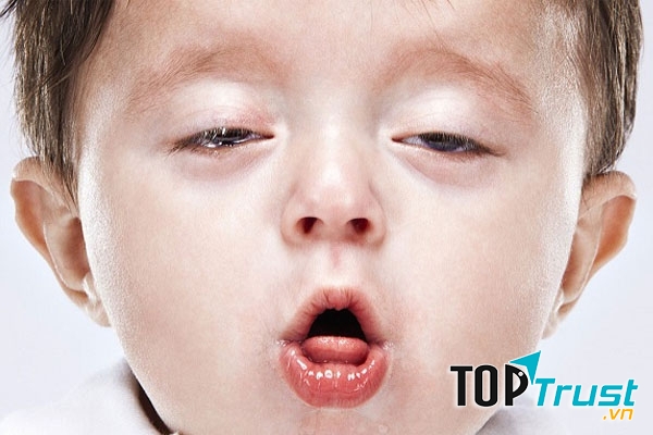 Ho và sổ mũi ở trẻ