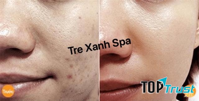 Tre xanh Spa