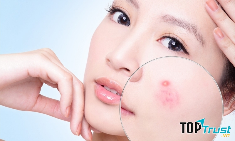 Tỏi vị thuốc hữu hiệu trong điều trị mụn