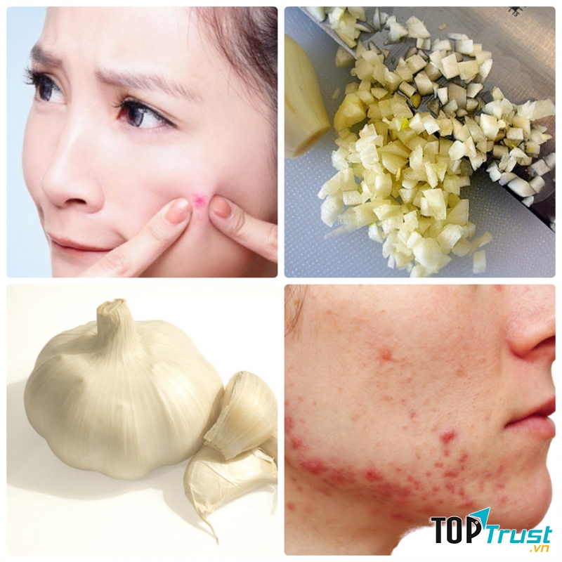 Tỏi vốn là nguyên liệu thiên nhiên trị mụn ẩn dưới da rất hiệu quả.