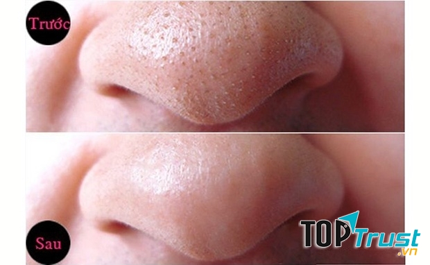 Mụn đầu đen sẽ bị đánh bay với tinh dầu thầu dầu