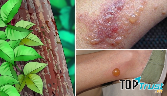 Trị vết ngứa do cây thường xuân độc gây ra