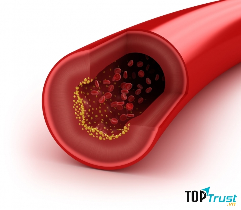 Cholesterol trong máu quá cao gây hại cho sức khỏe