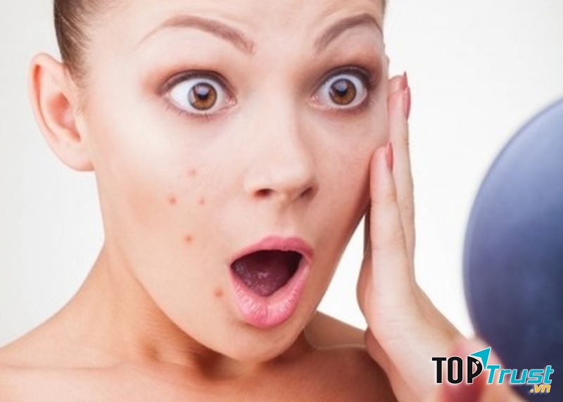 Mụn bọc, mụn trứng cá