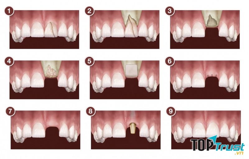 Mô phỏng kỹ thuật cấy xương trong trồng răng Implant