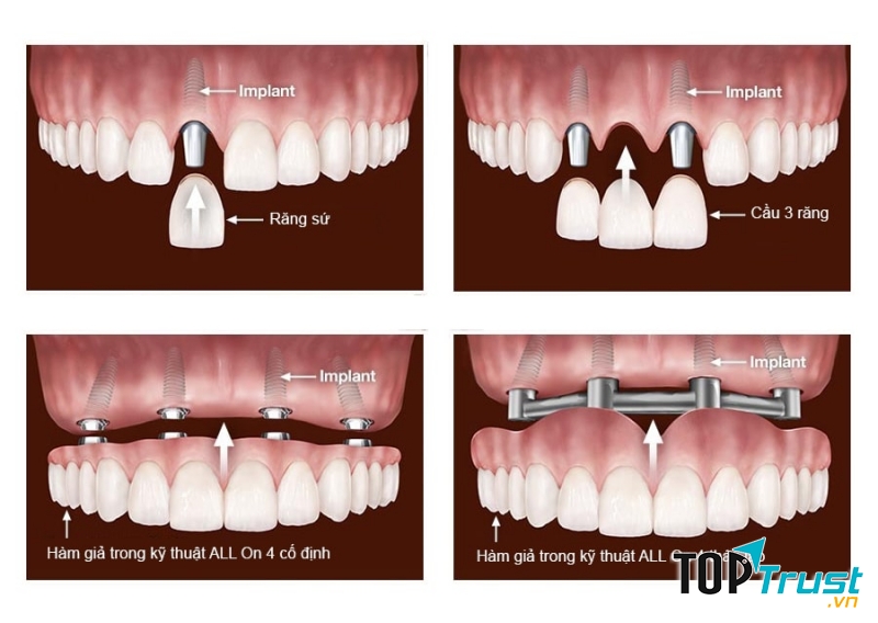 Các dạng phục hình trên Implant
