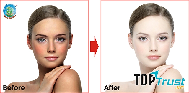 Hiệu quả rõ nét khi tắm trắng tại TMV Trương Kiều Xuân