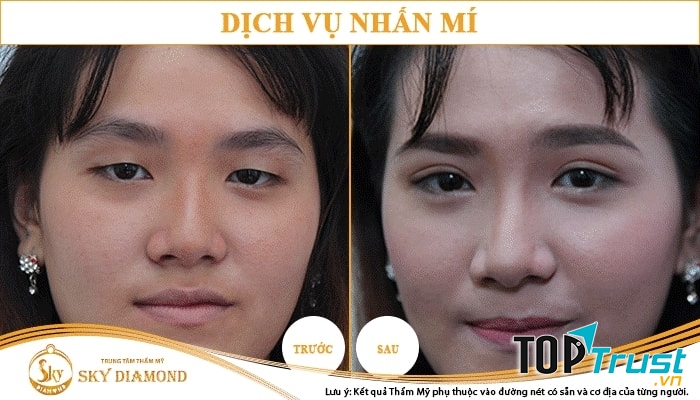 Trung Tâm Thẩm Mỹ Sky Diamond - địa chỉ nhấn mí mắt đẹp và an toàn nhất ở TP. HCM