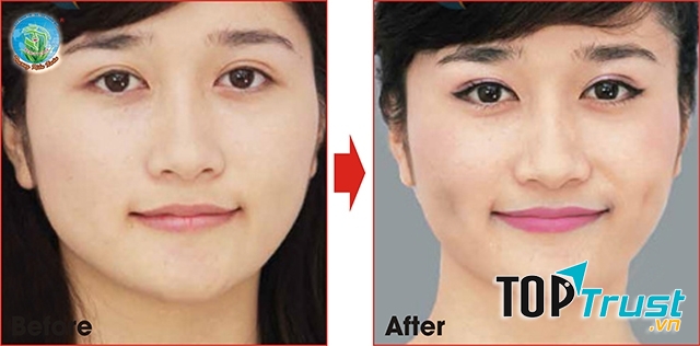 Khách hàng sau khi tạo má lúm tại TMV Trương Kiều Xuân