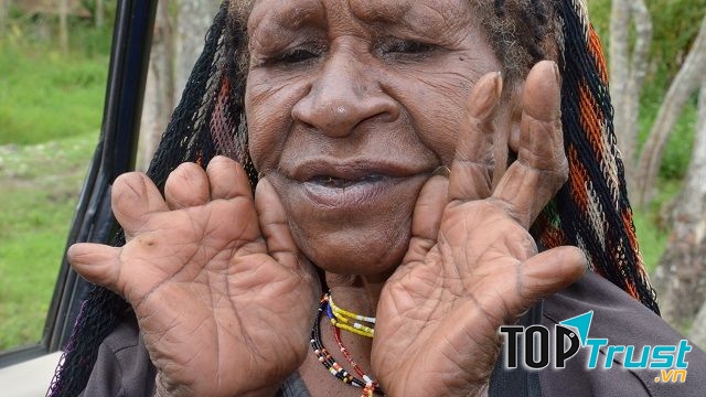 Tục cắt các đốt tay để tang cho người thân