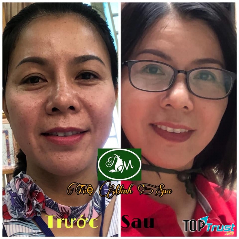 Trị nám tại Tuệ Minh Spa