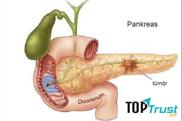 Tuyến tụy bị suy yếu hay nhiễm độc – nguyên nhân gây bệnh tiểu đường