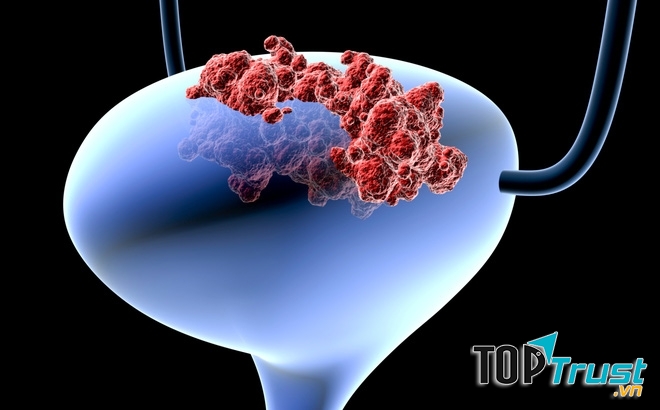 Ung thư bàng quang là một loại ung thư bắt đầu trong bàng quang