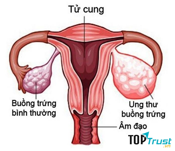 Ung thư buồng trứng là căn bệnh phổ biến đứng ở vị trí thứ 5 ở phụ nữ