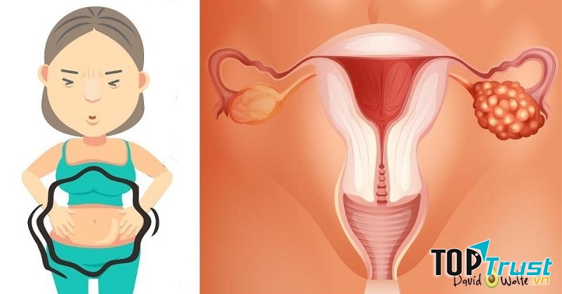 Ung thư buồng trứng