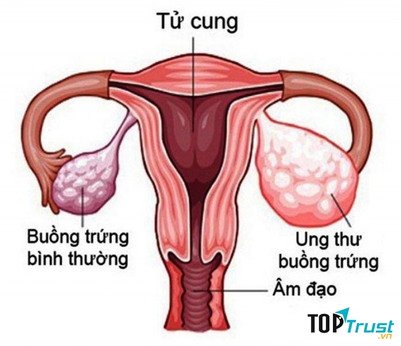 Ung thư buồng trứng