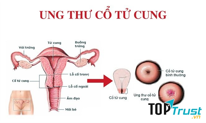 Thuốc lá có thể gây ung thư cổ tử cung