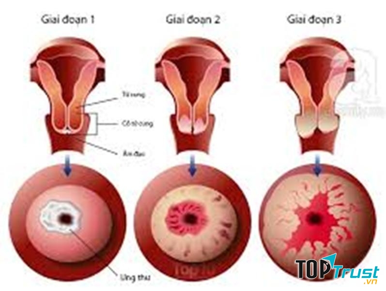 Hình ảnh các giai đoạn của ung thư cổ tử cung