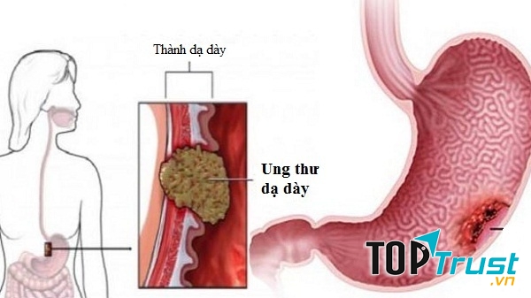 Ung thư dạ dày