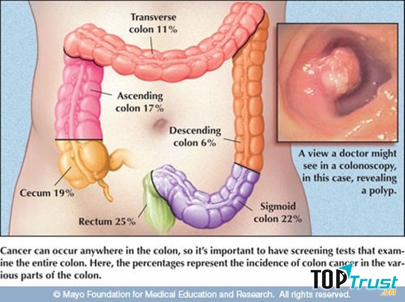 Hình ảnh trực tràng và đoạn trực tràng bị ung thư.