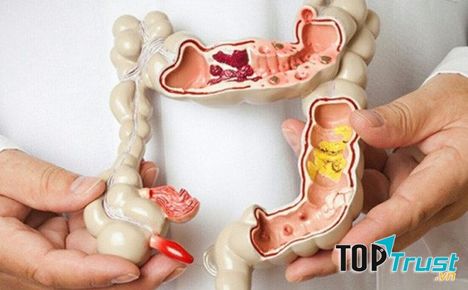 Thời gian dài ủ bệnh thì thông thường người bệnh sẽ không có triệu chứng cụ thể gì