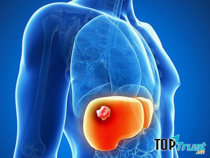 Chỉ số cơ thể không lành mạnh sẽ làm nguy cơ tăng ung thư gan