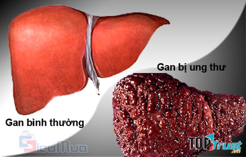 Lá gan bình thường và lá gan bị ung thư