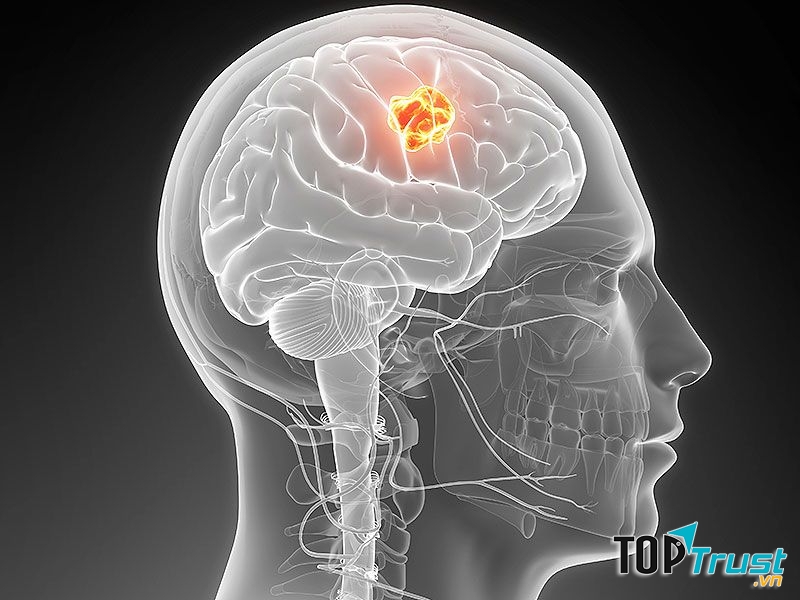 Ung thư não là căn bệnh vô cùng nguy hiểm