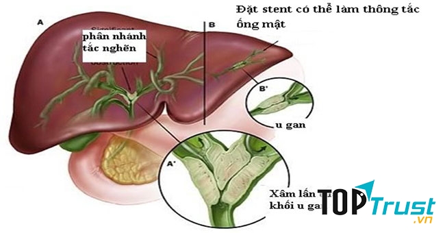 Ung thư ống mật