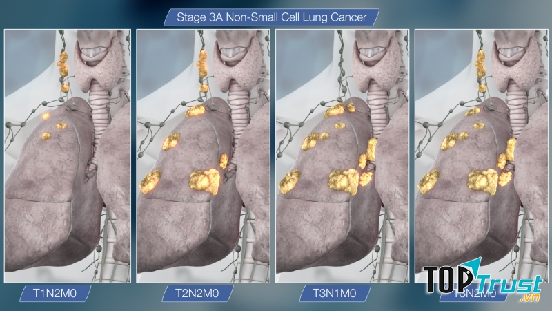 Ung thư phổi giai đoạn 3A