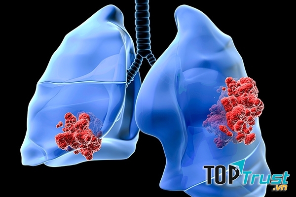 Ở các giai đoạn đầu, bệnh này hầu như không có dấu hiệu gì.