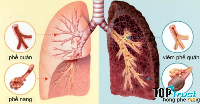 Hình ảnh lá phổi ung thư (bên phải) và lá phổi lành (bên trái)