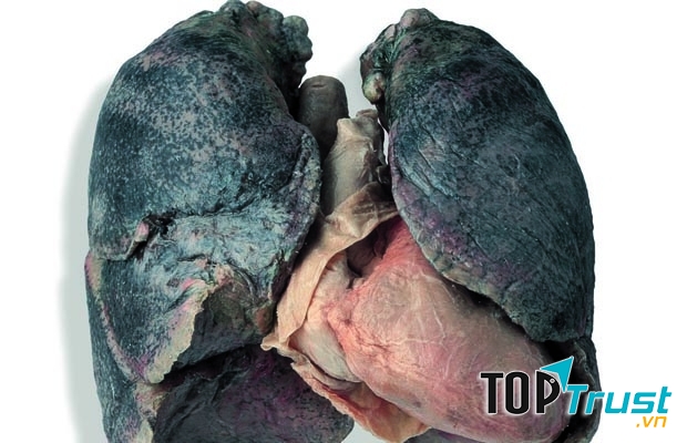 Phổi bị nám đen