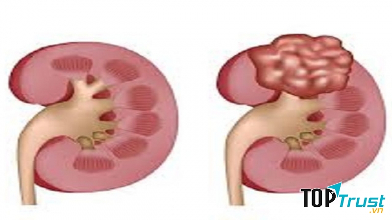 Ung thư thận do thừa cân béo phì.