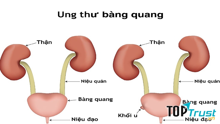 Ung thư bàng quang
