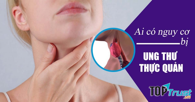 Người béo phì rất dễ mắc ung thư thực quản.