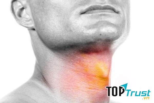 Ung thư thực quản